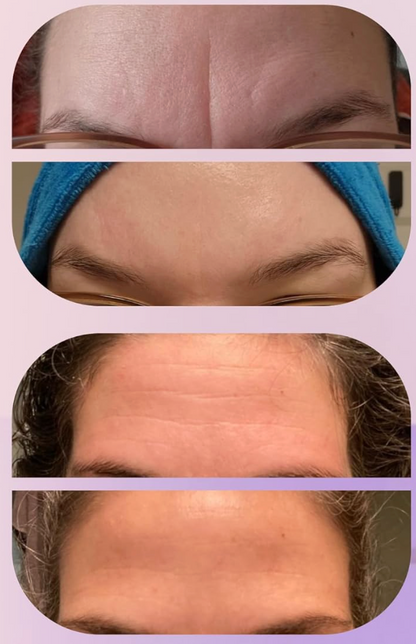 Parches de Colágeno para la Frente – Arrugas suavizadas en minutos